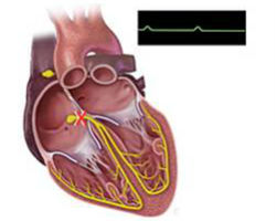 Heart-Block