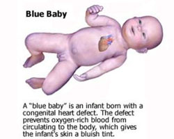 "blue baby" symptom