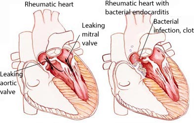 rheumatic heart